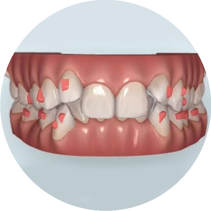 Invisalign