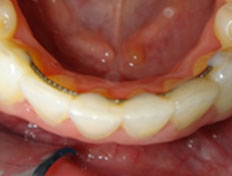 Braces