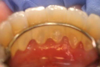 Clear Braces