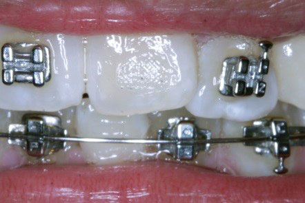 Length of Treatment