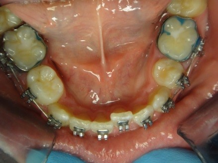 Length of Treatment