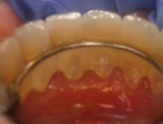 Braces