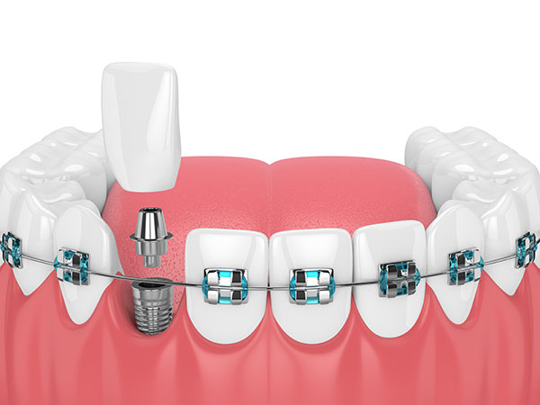 Clear Braces