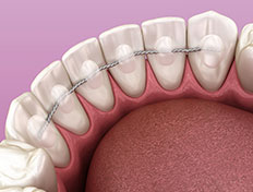 Braces