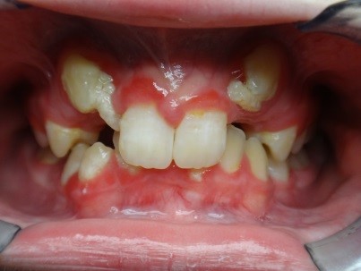 Eating with Braces