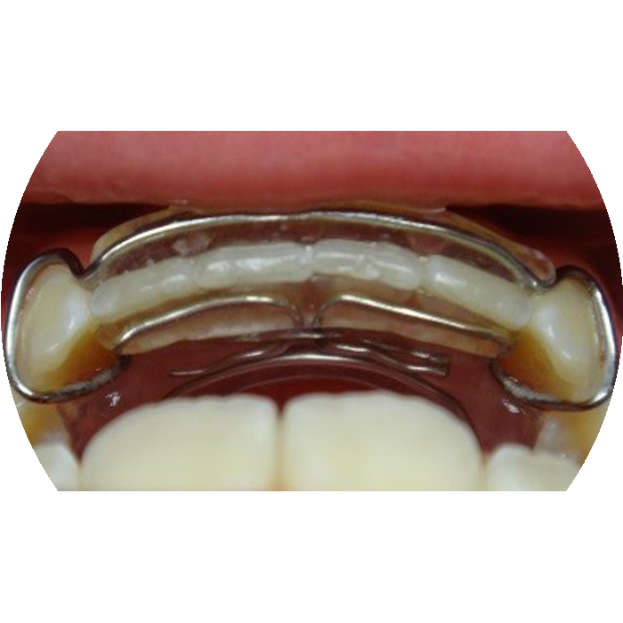 CLEAR BRACES