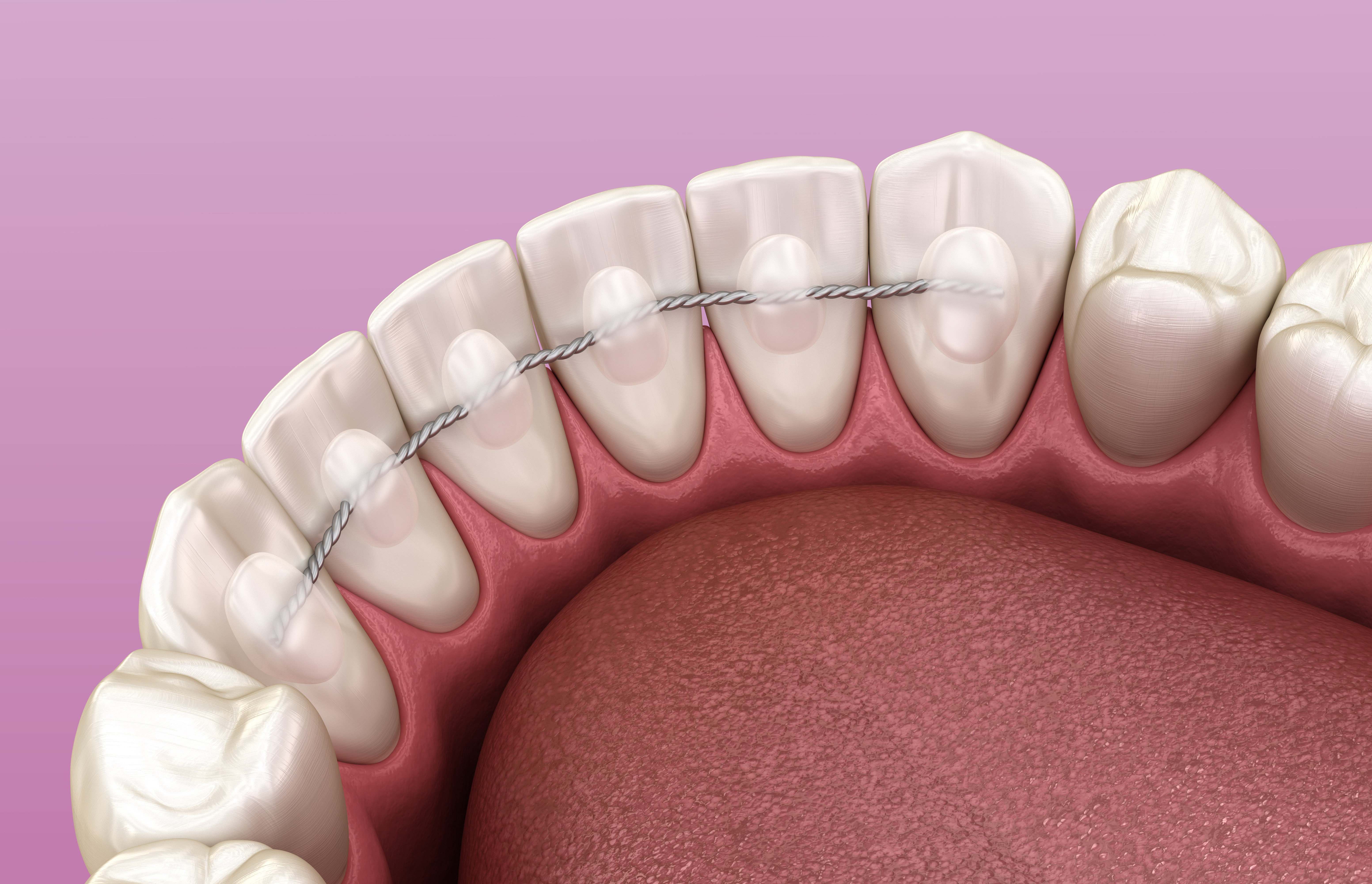 CLEAR BRACES