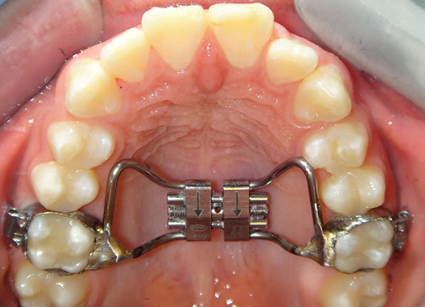 Emergency Orthodontic Care